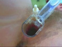 my extreme anal and speculum solo